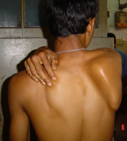 Figure 3.2 — Medial Scapular Winging (Long Thoracic Nerve Palsy)