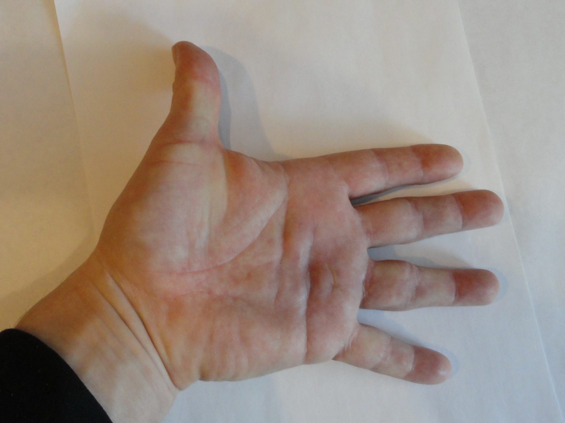 Figure 7.3 — Dupuytren Contracture Clinical Presentation