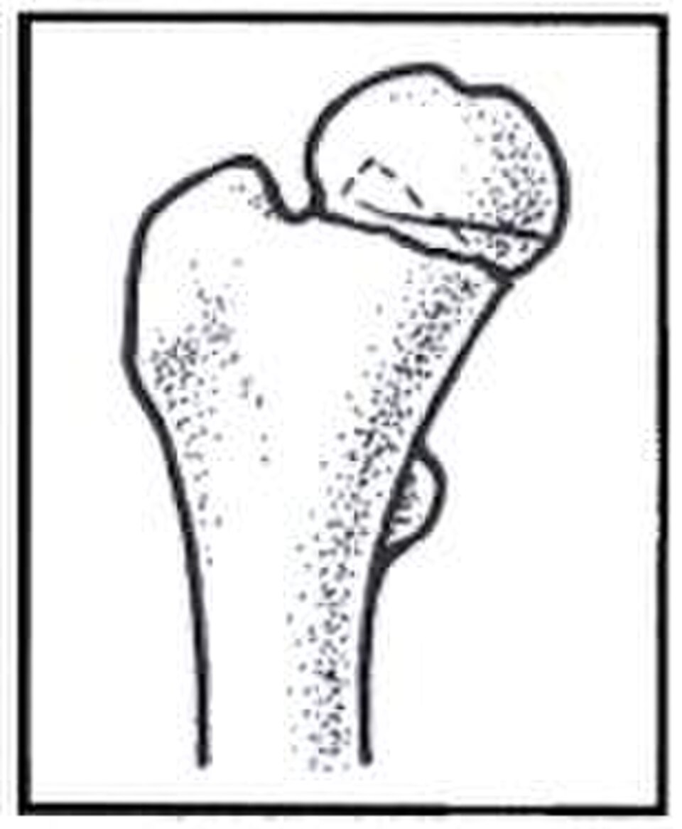 Figure 9.2 — Line drawing of a fractured femoral neck (Garden classification reference); see text for full Garden I-IV displacement criteria.
