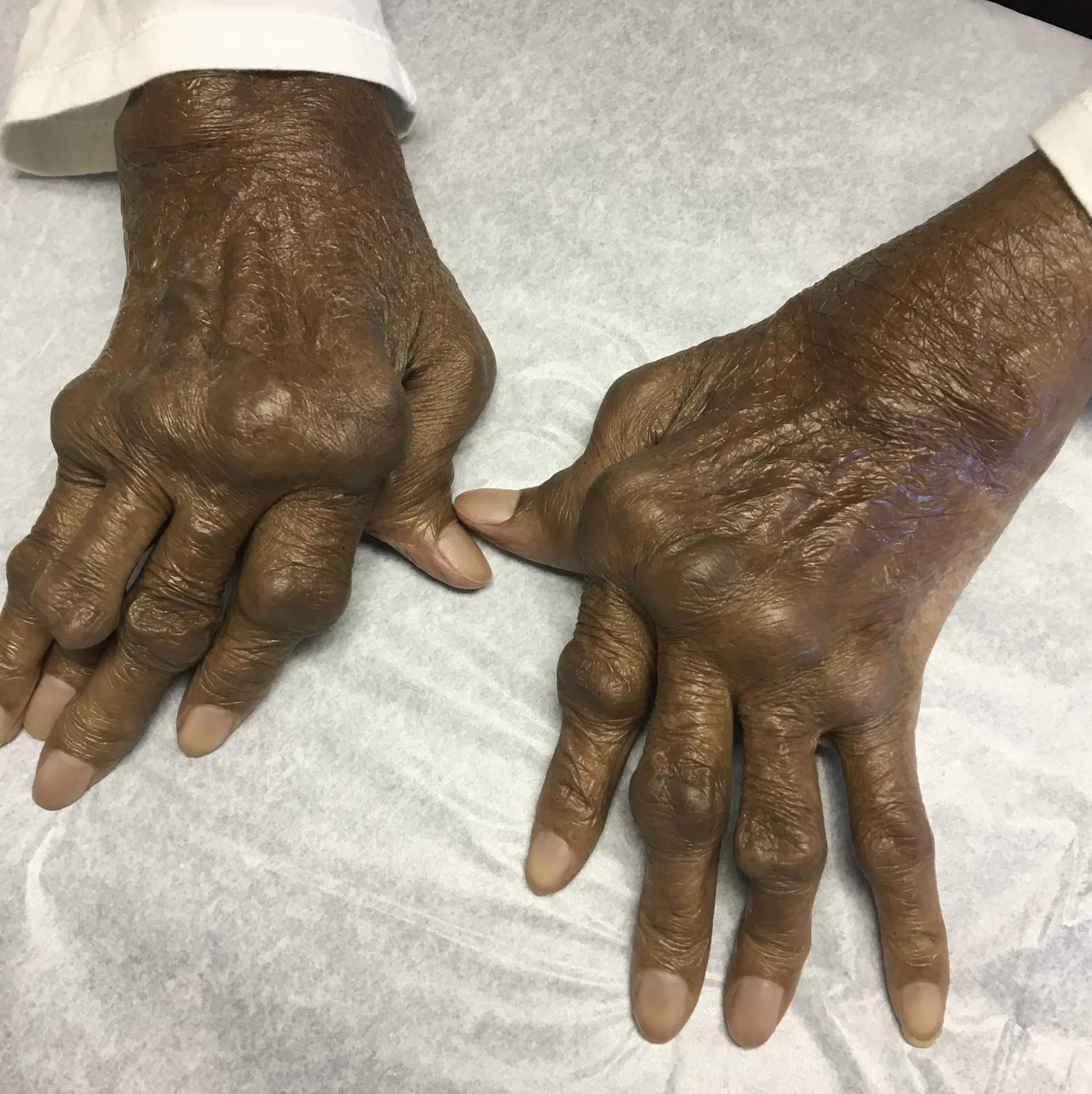 Figure 20.2 — Severely deformed hands of advanced rheumatoid arthritis: bilateral MCP ulnar deviation with associated swan-neck and boutonnière finger deformities and Z-thumb posturing. Pannus erodes from the joint margin inward; the deformities follow ligament and tendon failure rather than primary bone destruction.