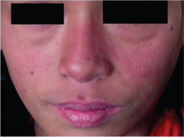 Figure 21.7 — SLE malar (butterfly) rash: confluent erythema across both cheeks and the bridge of the nose with characteristic sparing of the nasolabial folds (rosacea by contrast floods the folds). Discoid lupus lesions (not pictured) are raised, coin-shaped, hyperkeratotic plaques that scar with central hypopigmentation and can cause alopecia.
