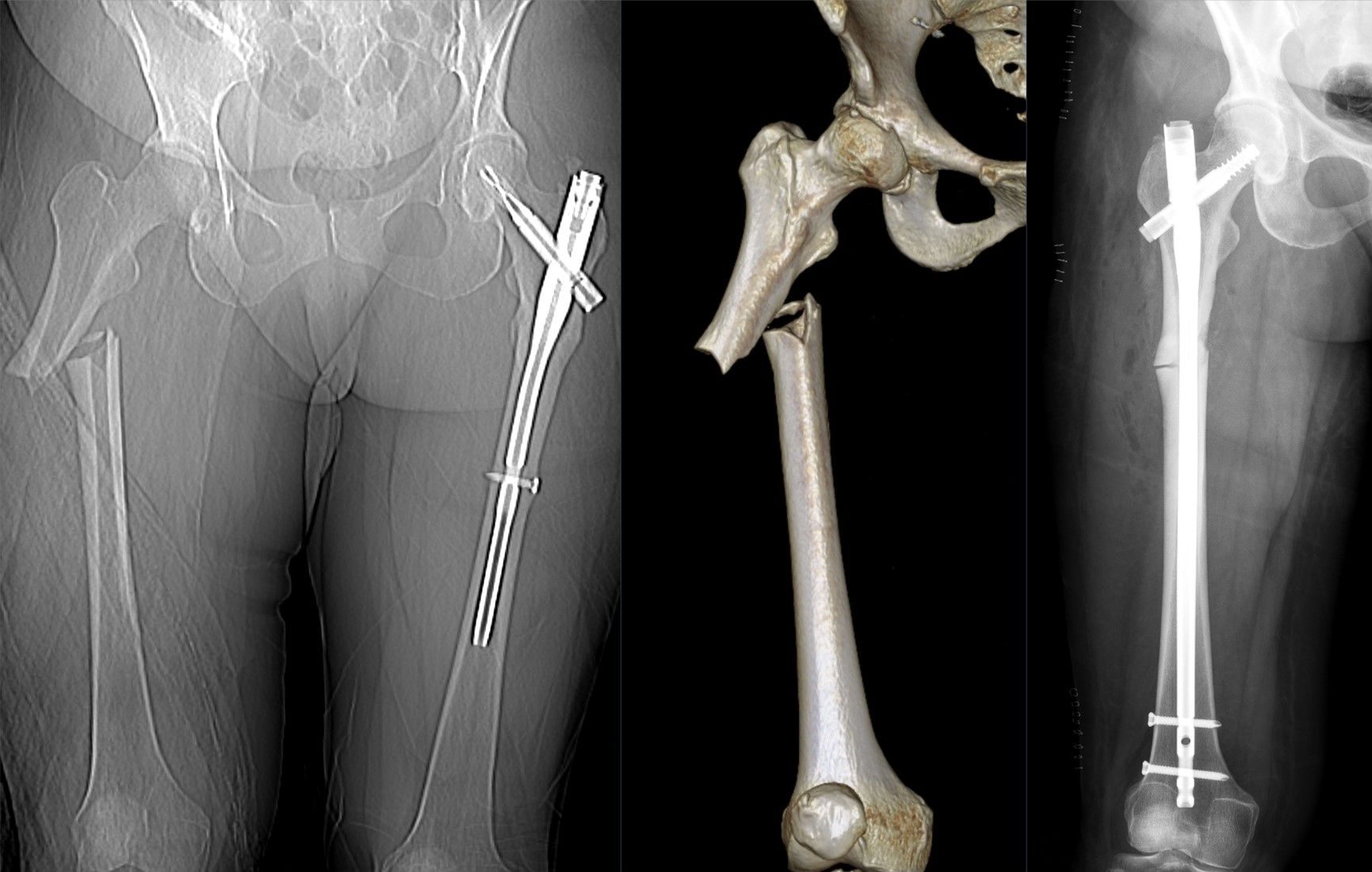 Figure 24.6 — Atypical Femur Fracture from Bisphosphonate Therapy (CT topogram + Postoperative Radiograph)