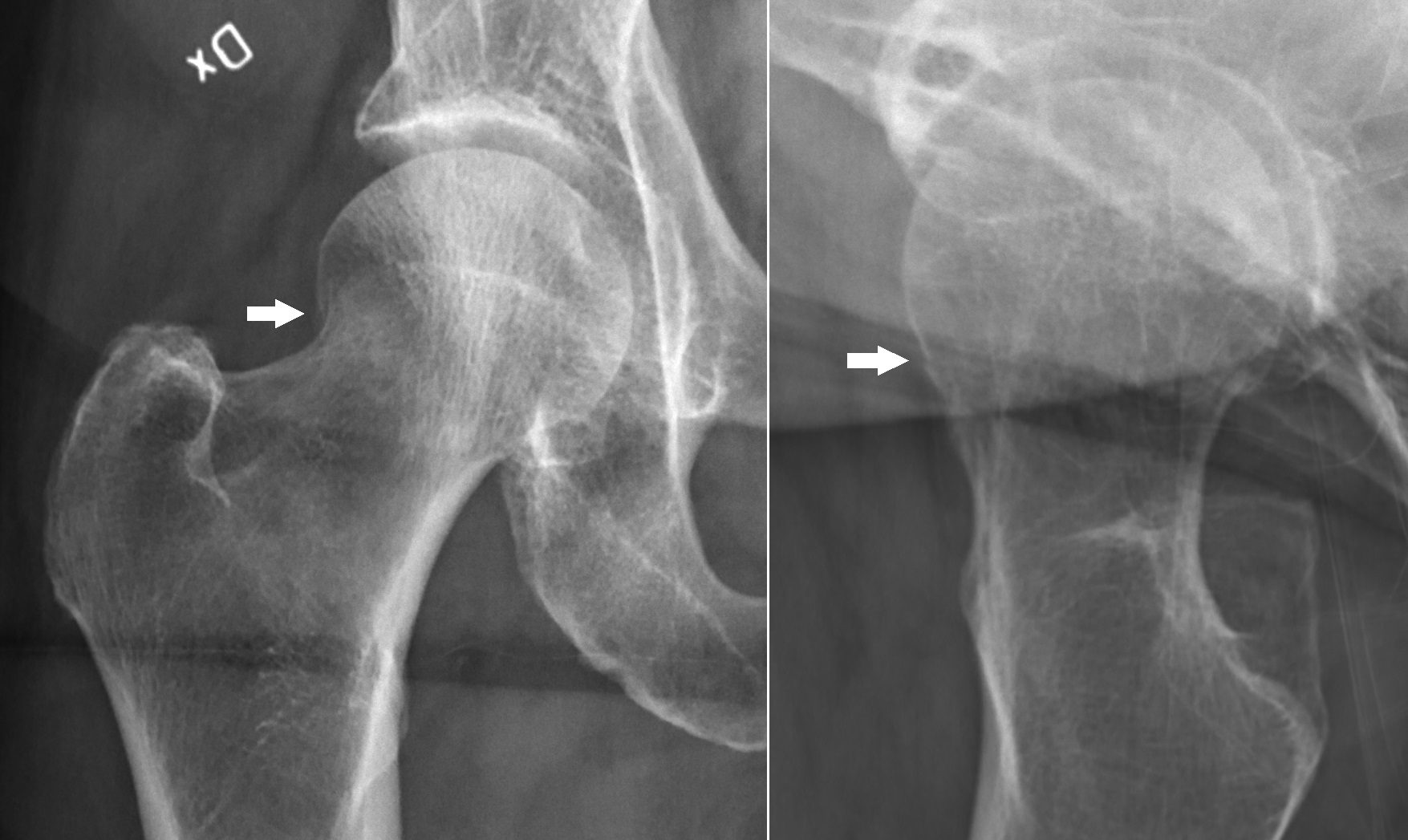 Figure 24.7 — Mildly Compressed Intertrochanteric Hip Fracture (Annotated)