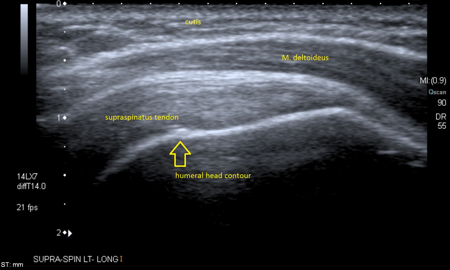 Figure 25.7 — Longitudinal Ultrasound of Supraspinatus Tendon Showing Fibrillar Echotexture