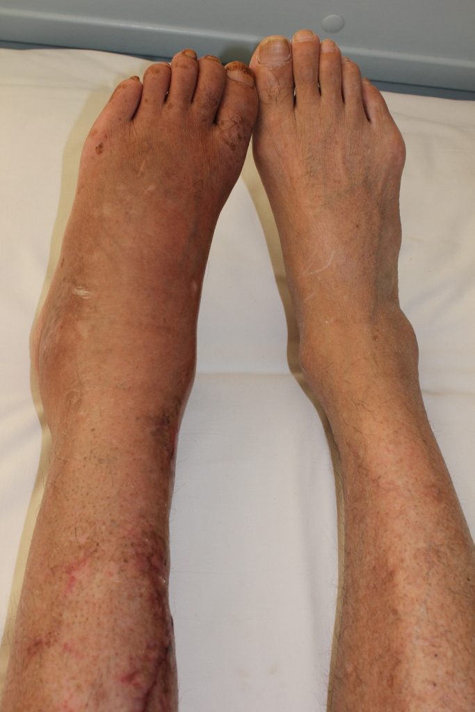 Figure 28.7 — CRPS Type I in Lower Extremity, 6 Months Post-Tibial Fracture