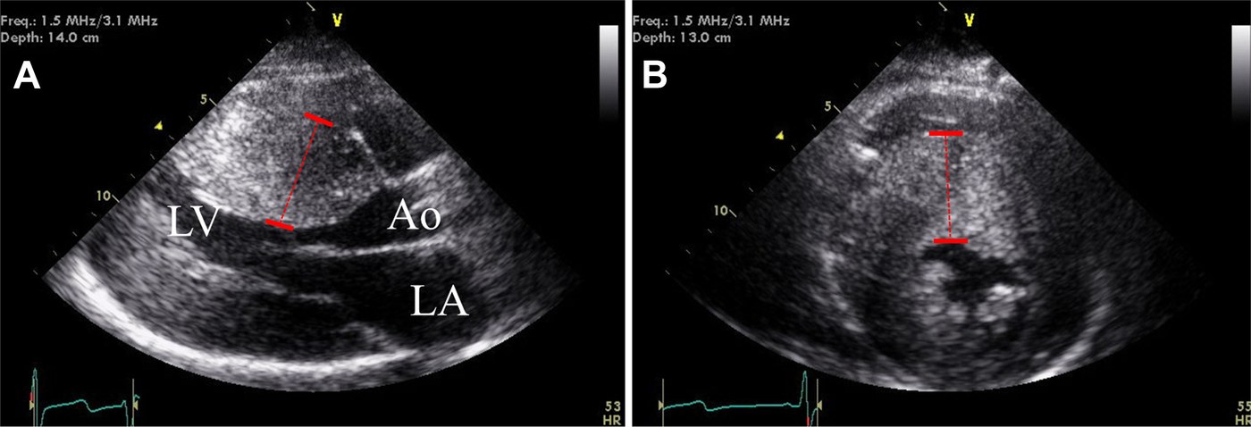 Figure 30.6 — HCM Echocardiogram: Parasternal Long-Axis (A) and Short-Axis (B) Views in Diastole Showing Asymmetric Septal Hypertrophy (Septum 35 mm)