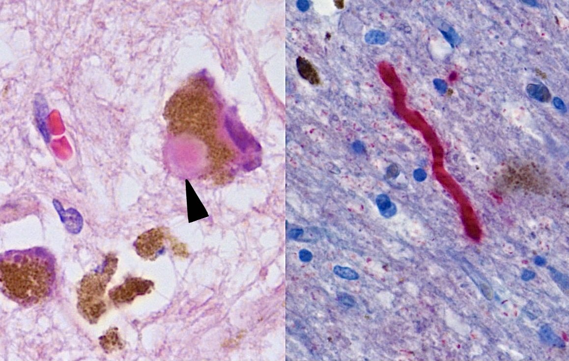 Figure 3.07 — Substantia Nigra Histopathology: Lewy Body and Alpha-Synuclein-Positive Lewy Neurite in Parkinson Disease