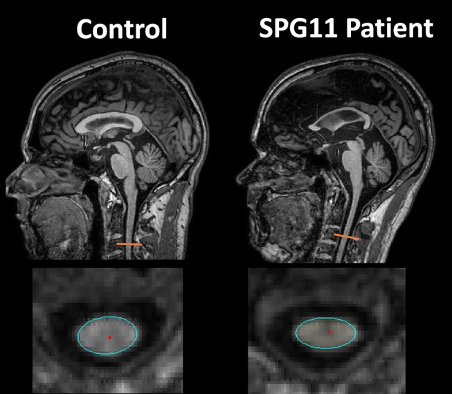 Figure 6.6 — Spinal Cord MRI: HSP Cord Atrophy (SPG11). Sagittal T1 (top) and axial T1 (bottom) MRI comparing a healthy control (left) with a patient with hereditary spastic paraplegia type 11 (SPG11, right). The patient demonstrates cervical spinal cord atrophy and antero-posterior flattening (orange marker, sagittal; cyan outline, axial cross-section) with a symmetric reduction in cord cross-sectional area. Atrophy without focal plaques or enhancement on the T2 and post-contrast sequences (not shown here) is the imaging signature that distinguishes length-dependent corticospinal degeneration in HSP from MS, NMOSD, or transverse myelitis.