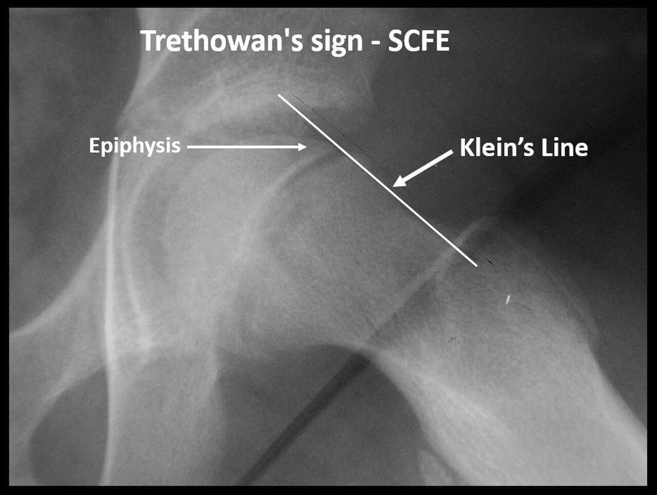 Figure 9.4 — Slipped capital femoral epiphysis (SCFE) with Klein line drawn along the superior femoral neck failing to intersect the femoral head (“ice cream falling off cone”). The line is classically drawn on the AP pelvis; this film is a lateral projection, where the same relationship is often traced.