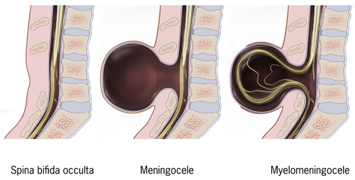 Figure 3.1 — Spectrum of spina bifida: occulta (vertebral arch defect, intact skin, no MSAFP elevation), meningocele (sac with meninges only, MSAFP elevated when the sac is open, better prognosis), and myelomeningocele (sac with meninges and exposed neural tissue, MSAFP elevated, the most clinically significant NTD). Lipomyelomeningocele (closed dysraphism with lipoma adherent to cord) is a related closed form not pictured.