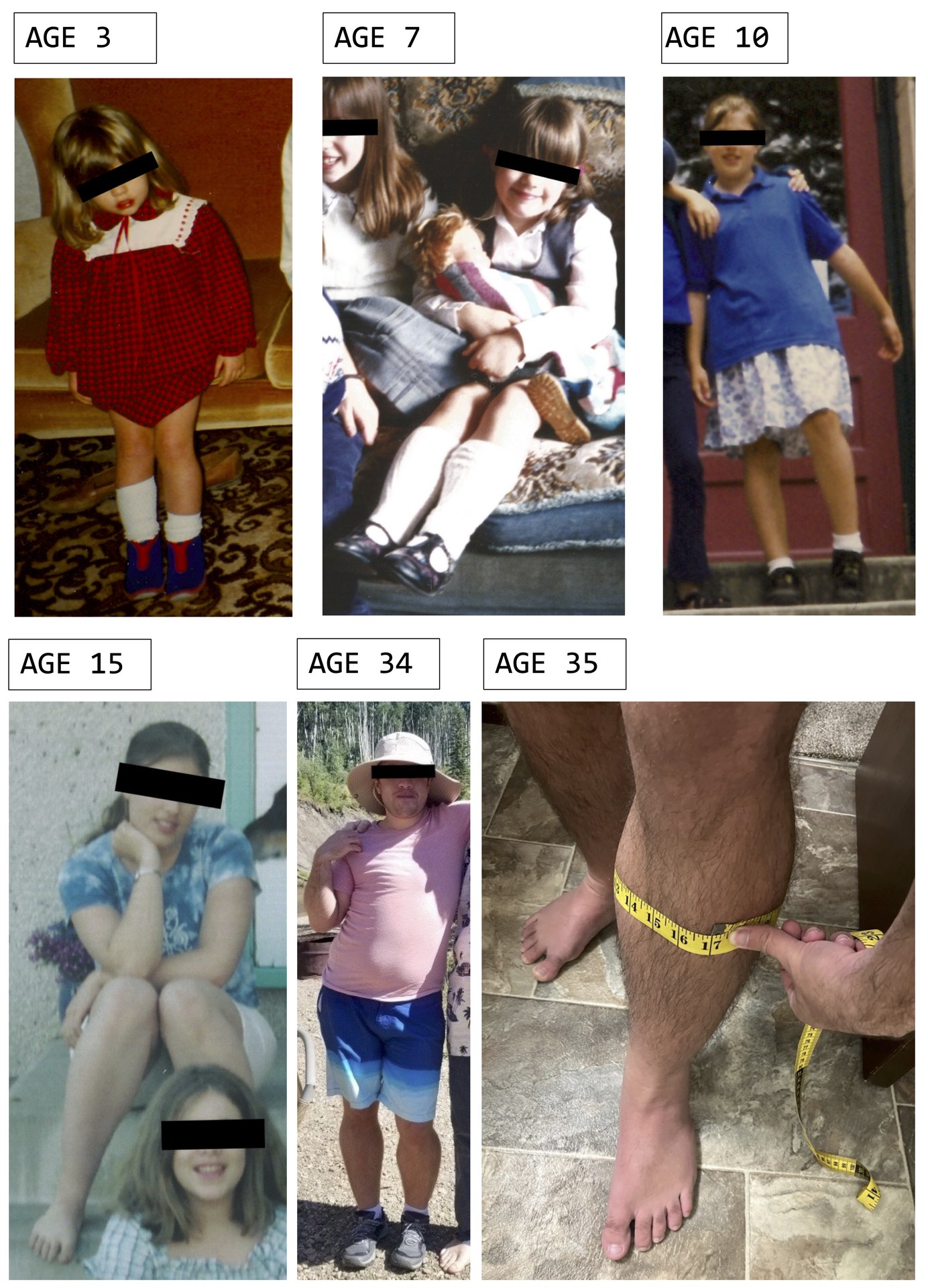 Figure 4.2 — Bilateral calf pseudohypertrophy: the enlarged calves are not true hypertrophy but replacement of muscle by fat and fibrosis, a classic clinical sign in boys aged 2 to 5 with Gower sign and lordotic Trendelenburg gait pointing to DMD.