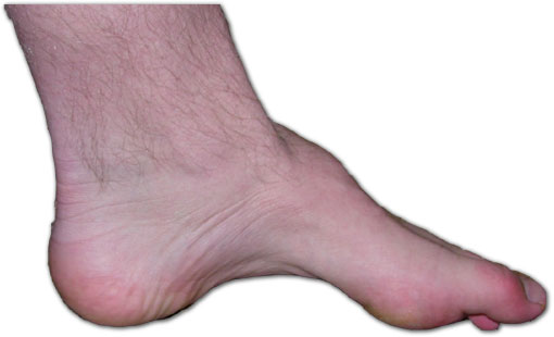 Figure 4.7 — CMT foot showing pes cavus and hammer toes.