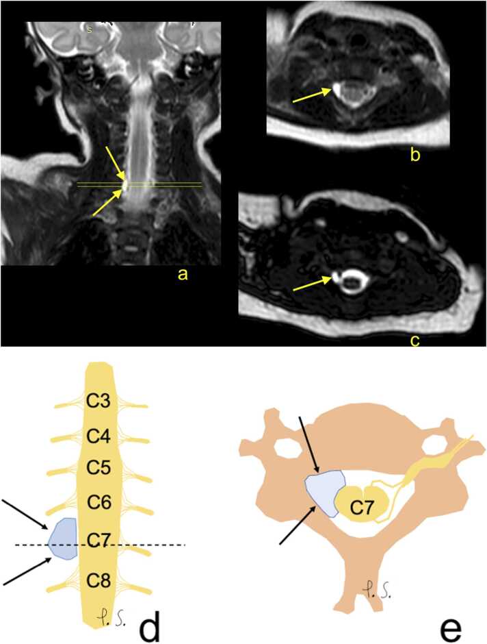 Figure 5.2 — Cervical MRI: pseudomeningocele at C6/C7 in brachial plexus injury (Erb’s palsy)