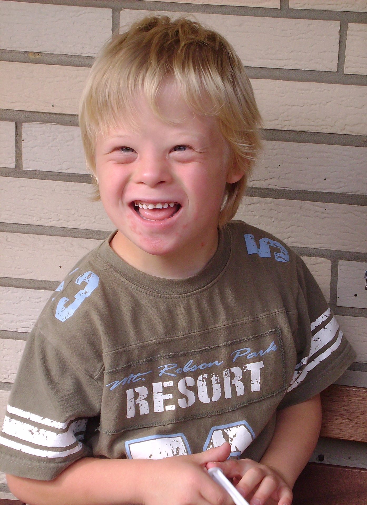 Figure 8.1 — Boy with Down syndrome demonstrating characteristic facies (upslanting palpebral fissures, epicanthal folds, flat nasal bridge, protruding tongue)