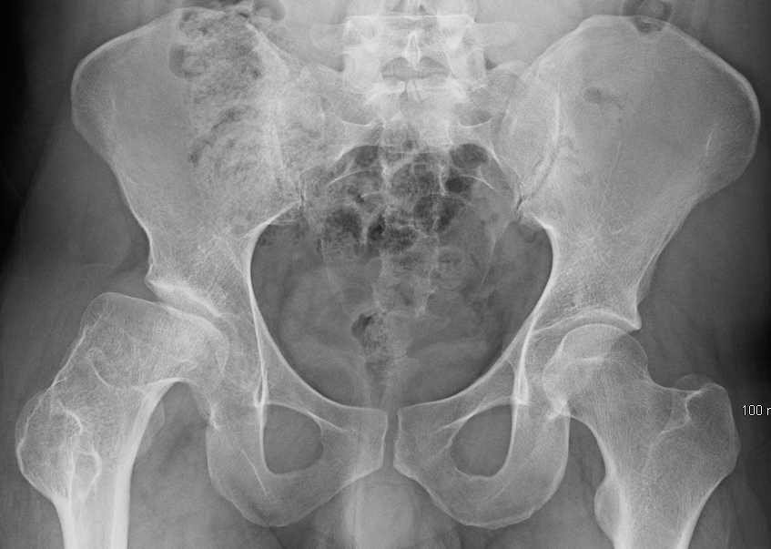 Figure 9.3 — Legg-Calvé-Perthes disease: AP pelvis radiograph showing femoral head AVN with fragmentation and lateral pillar collapse.