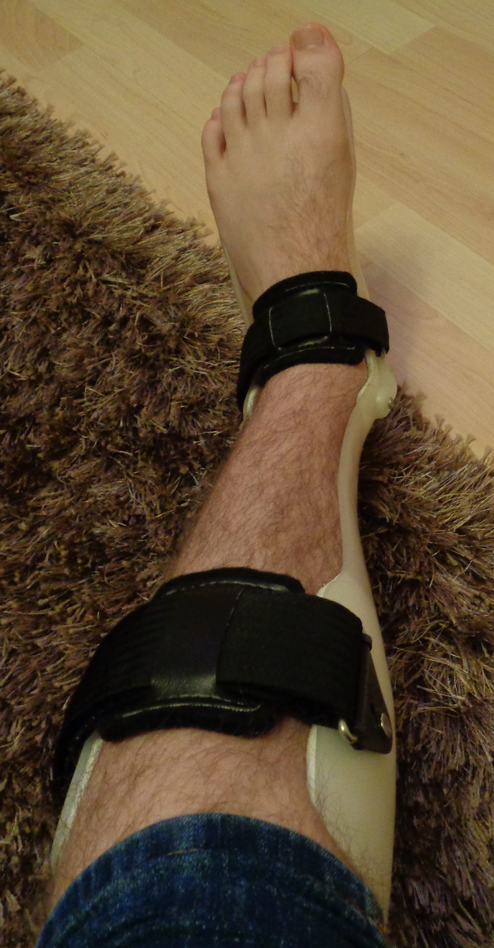 Figure 13.2a — Solid AFO (foot-drop / multiple sclerosis example)