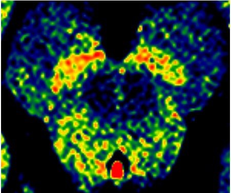 Figure 12.2 — Substantia nigra pars compacta on neuromelanin-enhanced axial midbrain MRI