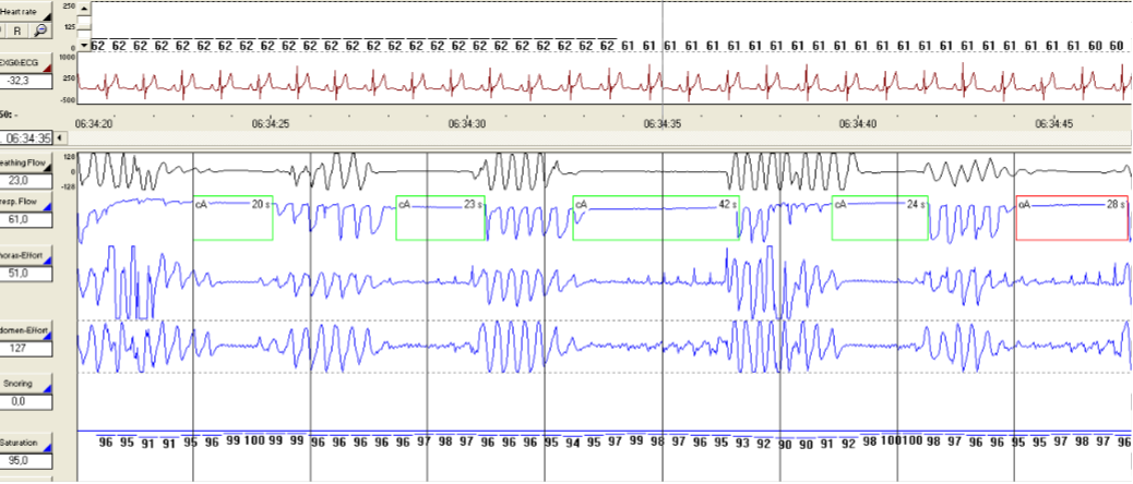 Figure 13.2 — Polysomnography montage showing multi-channel sleep recording