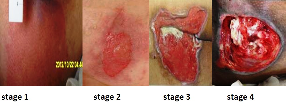Figure 12.1a — Clinical photographs illustrating pressure injuries