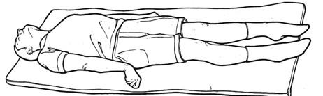 Figure 2.1b — Decerebrate posturing (UE extension-pronation, LE extension)