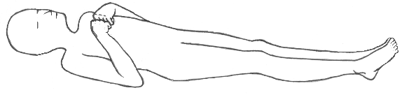 Figure 2.1a — Decorticate posturing (UE flexion-adduction, LE extension)