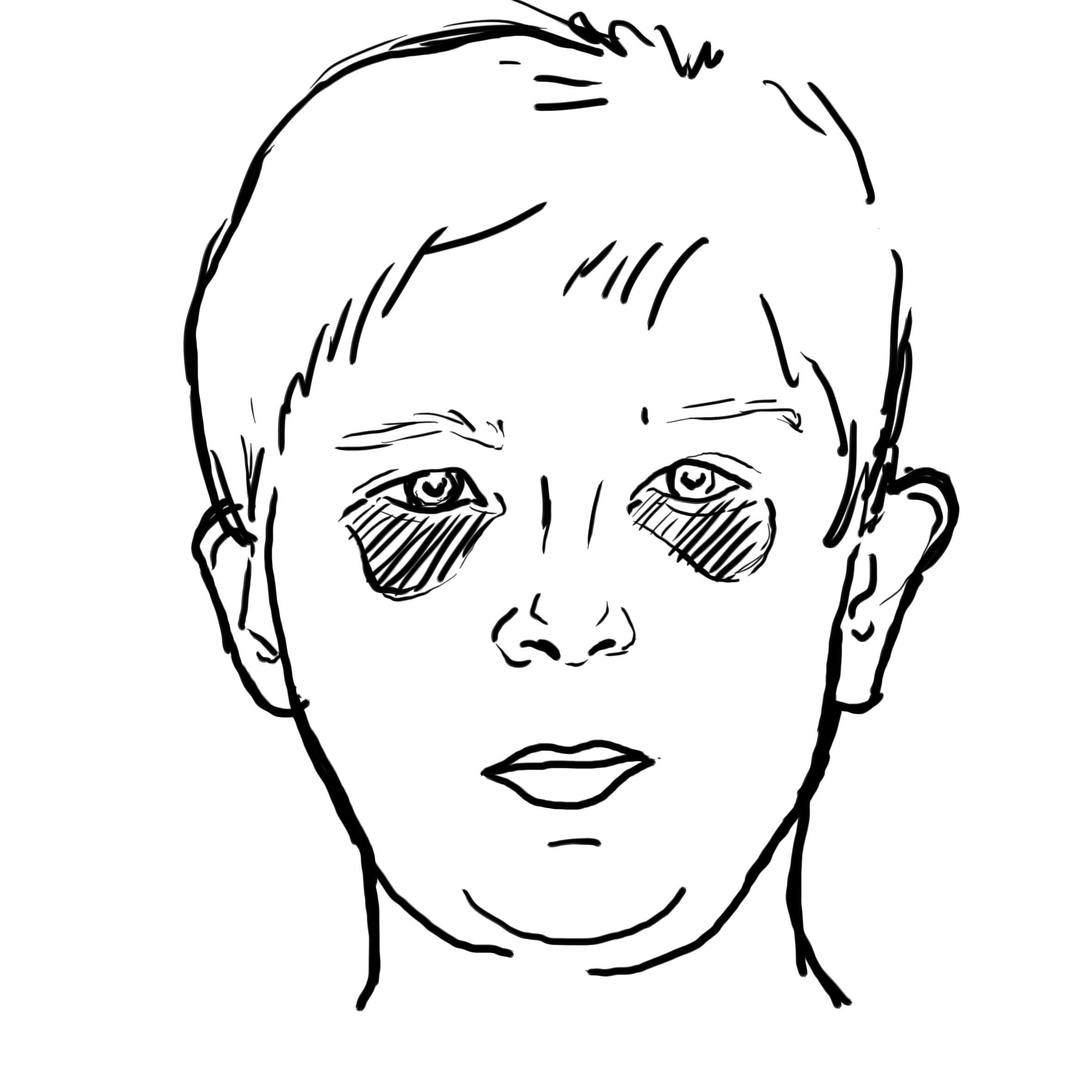 Figure 4.1b — Raccoon eyes: bilateral periorbital ecchymosis from basilar skull fracture